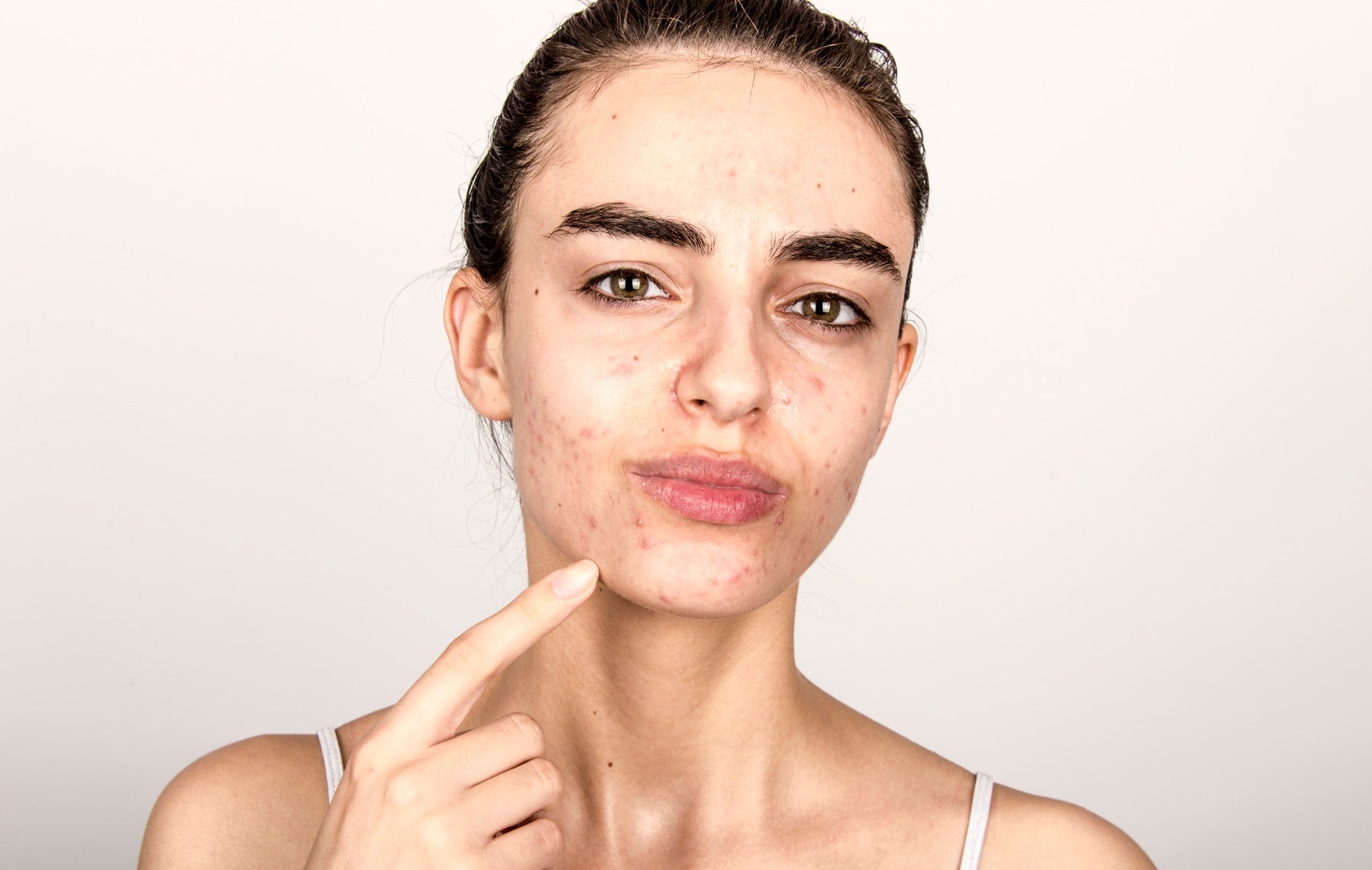 Péče o problematickou pokožku a akné